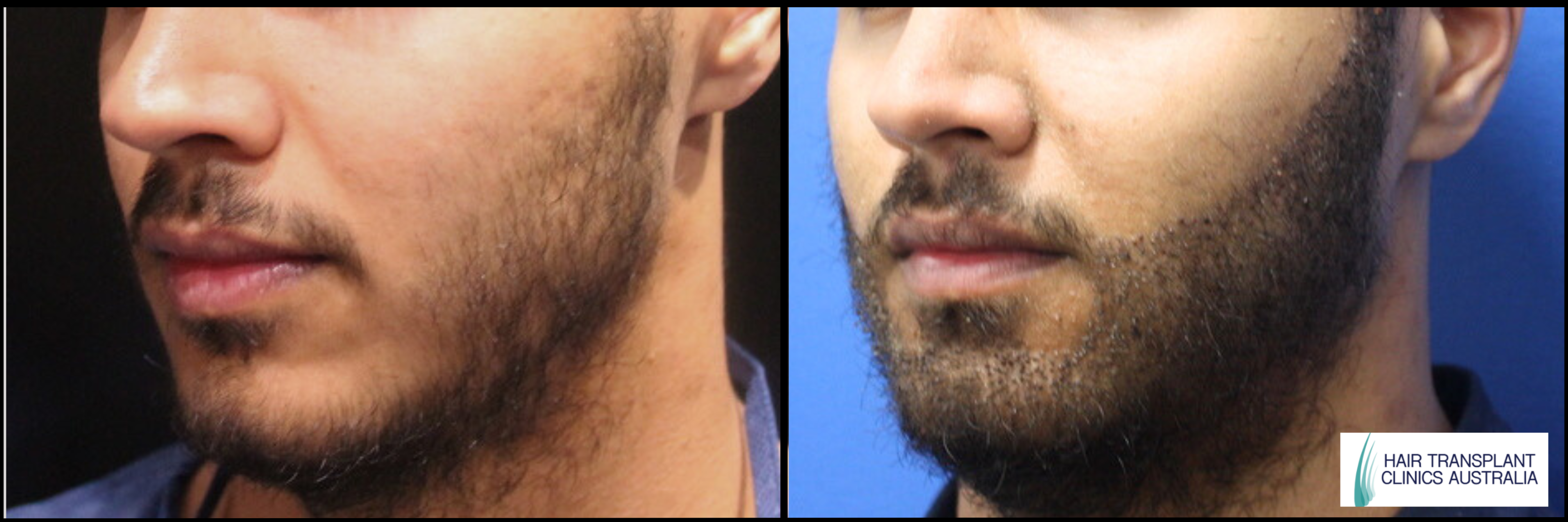 Beard FUE Before & After Image